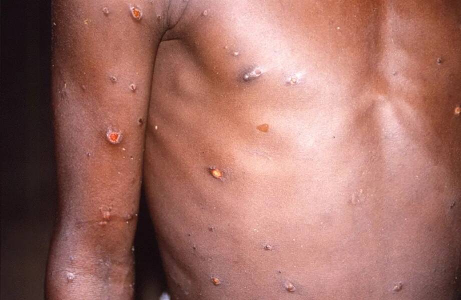 A varíola dos macacos ressurgiu na Nigéria em 2017, após mais de 40 anos sem casos relatados