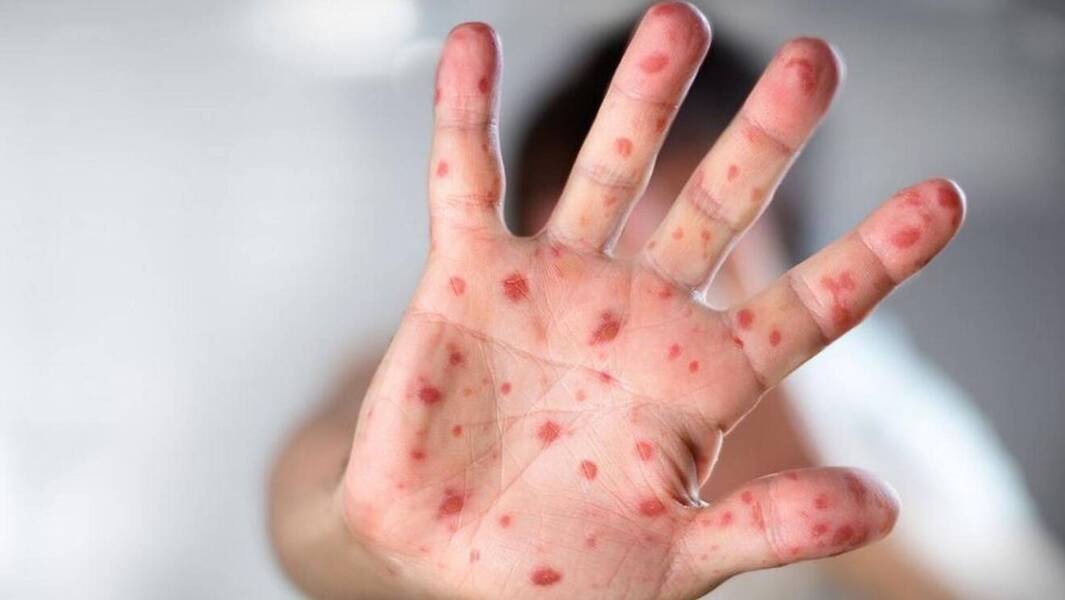 Os casos de varíola dos macacos no Brasil continuam subindo: mais de 1,7 mil, com São Paulo liderando os registros